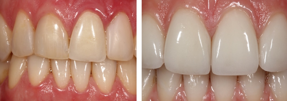Implant Crown Before and After